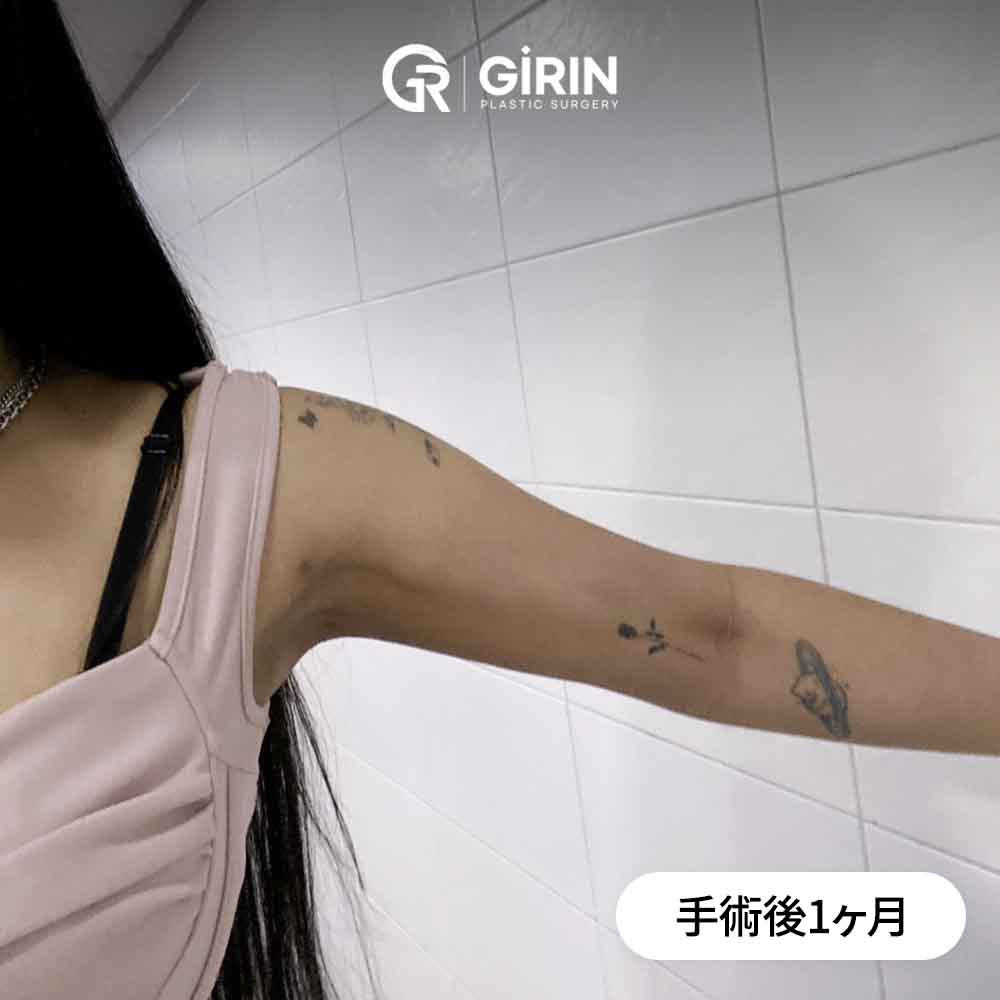 圧迫着が回復に不可欠