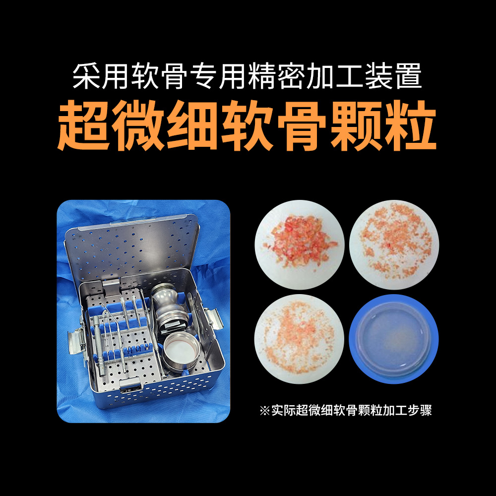 通过鼻内完成的驼峰鼻矫正过程，无需外部切口。