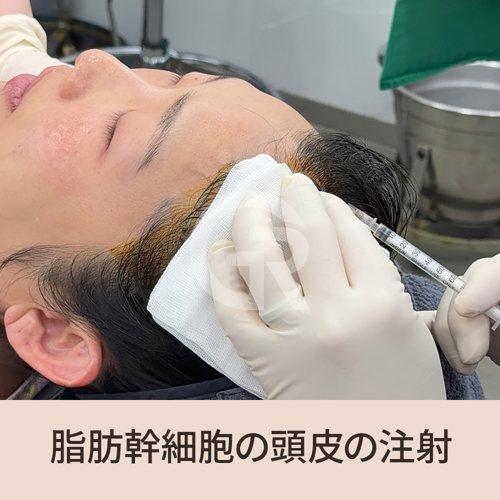 同じ毛包から生えているにもかかわらず髪が年々細くなるのは、頭皮環境の変化が大きく影響しています