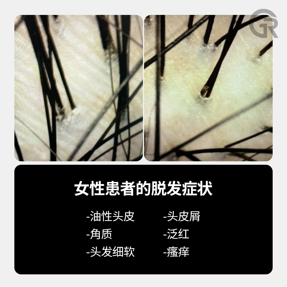 分缝稀疏、发量减少的头皮状态