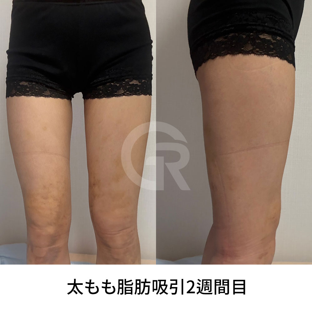 内ももの脂肪吸引は、脚の形、皮膚の弾力、全体のバランスを考慮して計画する必要があります。