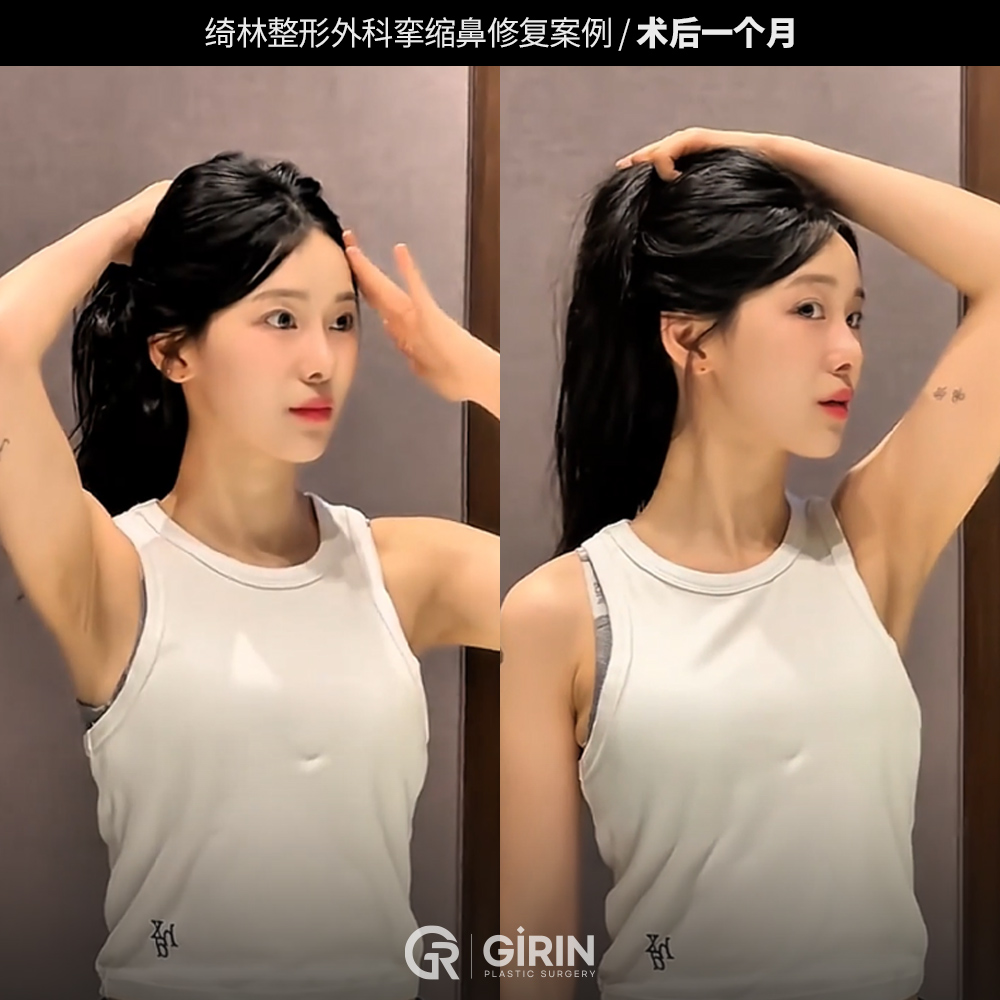 鼻整形术后恢复过程中的样子