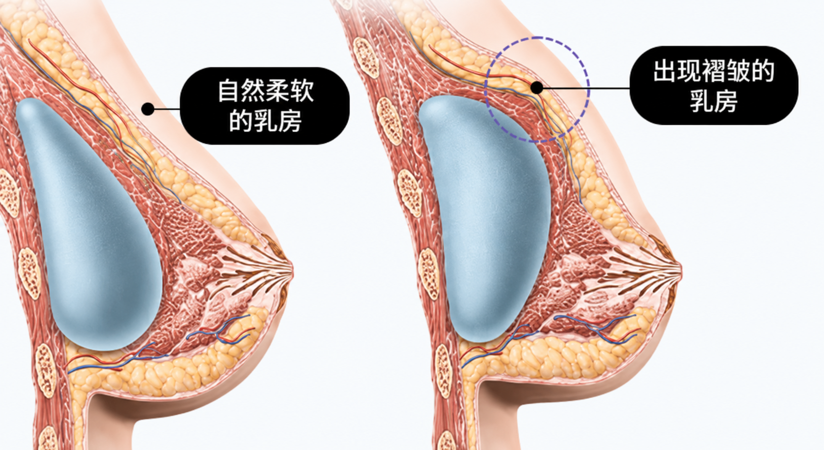 隆胸修复类型示意