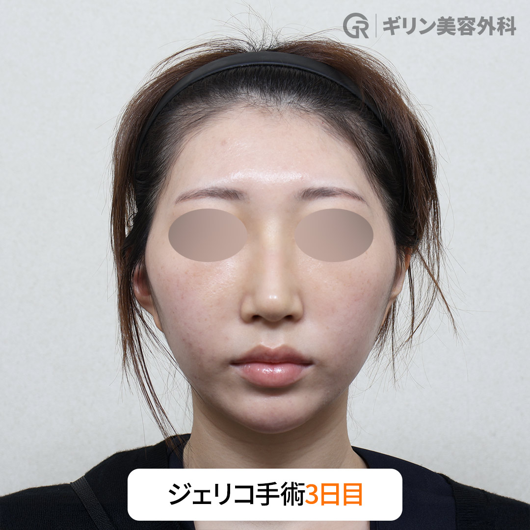 自家軟骨を利用し、自然で安定した仕上がりを実現