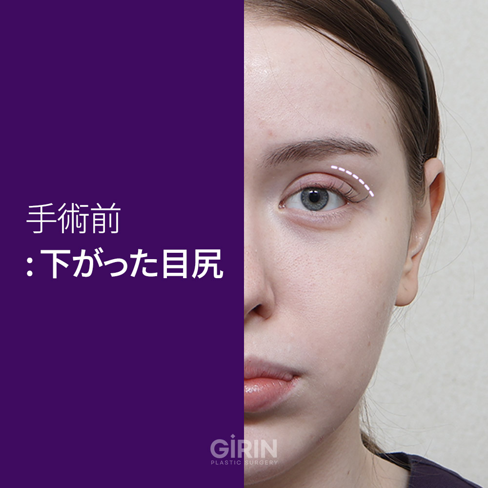回復過程：術後の傷跡は徐々に薄くなります。