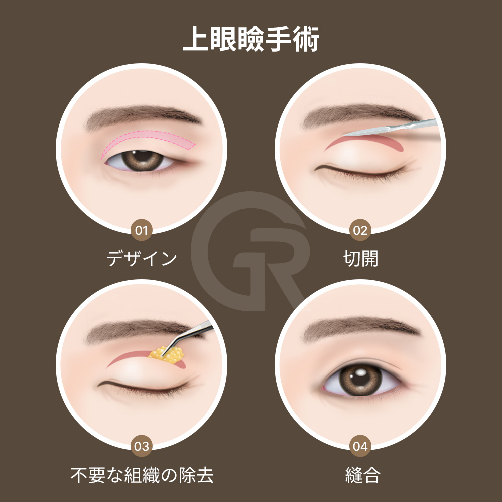 手術を選ぶ前に、眉下リフトと上眼瞼手術の違いを理解することが重要です。