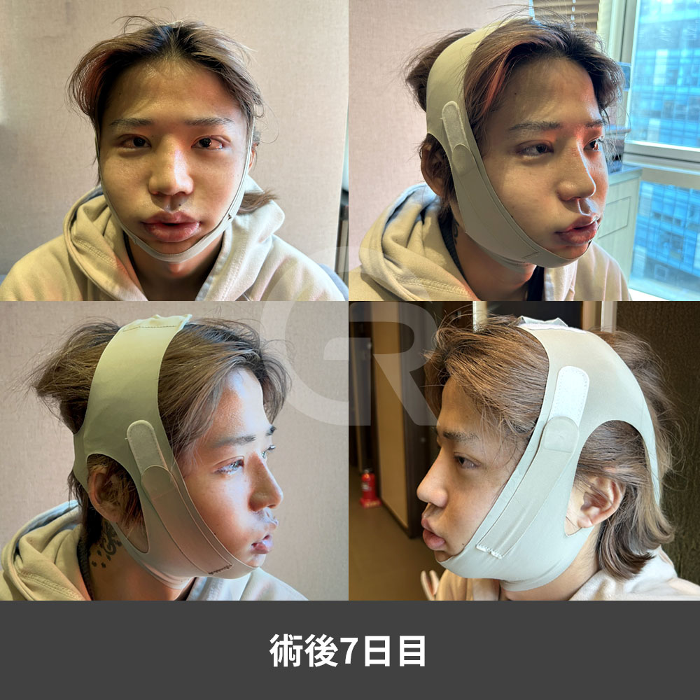 韓国の男性向け自然鼻整形では、顔全体の構造に合うストレートまたは半ストレートの鼻ラインを重視します。