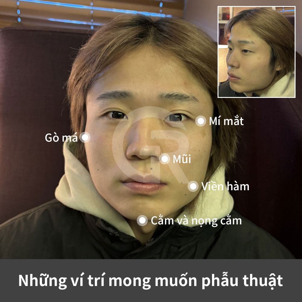 Phẫu thuật thẩm mỹ toàn gương mặt cho nam tại Hàn Quốc có thể cải thiện mắt, mũi, đường viền hàm và đường nét khuôn mặt trong khi vẫn giữ khí chất vốn có của bệnh nhân.