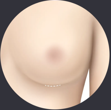 乳房下皱襞切口