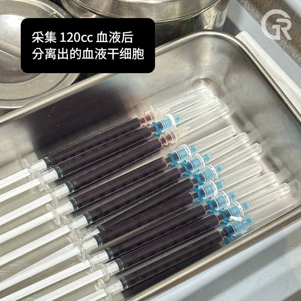 生长因子头皮注射治疗过程