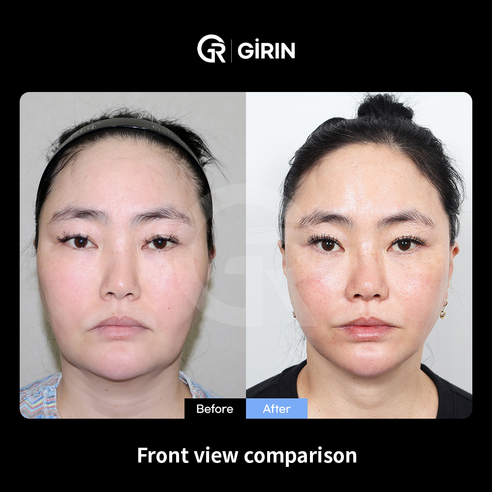 Midface sagging assessment during facelift consultation