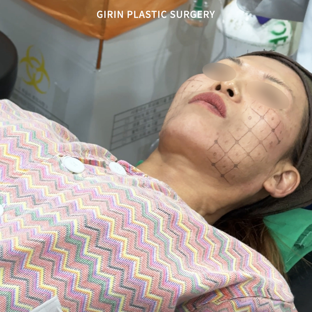 Уход после Thermage FLX