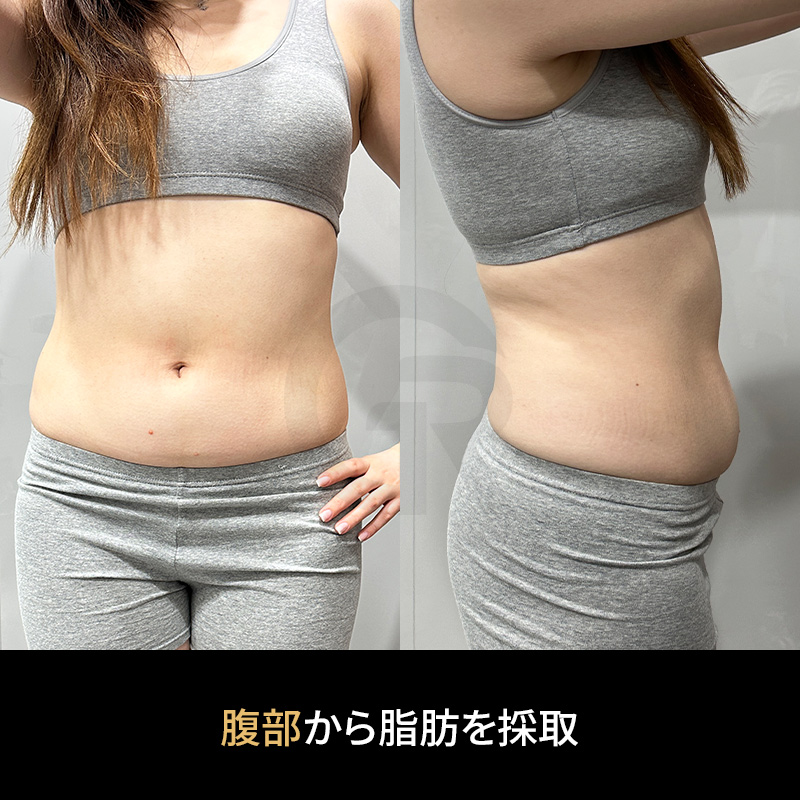 ソウルでは、脂肪由来幹細胞療法が皮膚再生を支える方法として紹介されることがあります。
