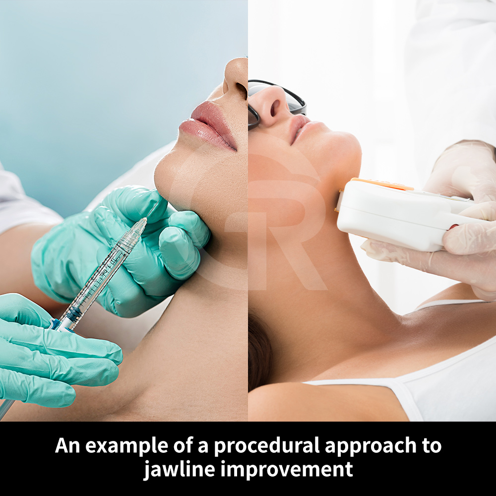 Chin liposuction combined with soft tissue repositioning