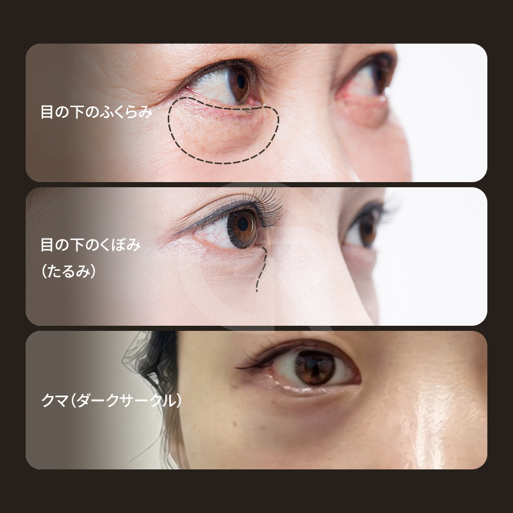 クマは影・色素・皮膚の薄さが重なって現れることが多いです。