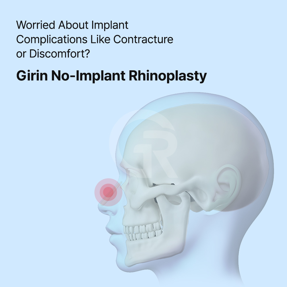 Closed rhinoplasty can improve a bulbous nose through incisions made inside the nostrils.