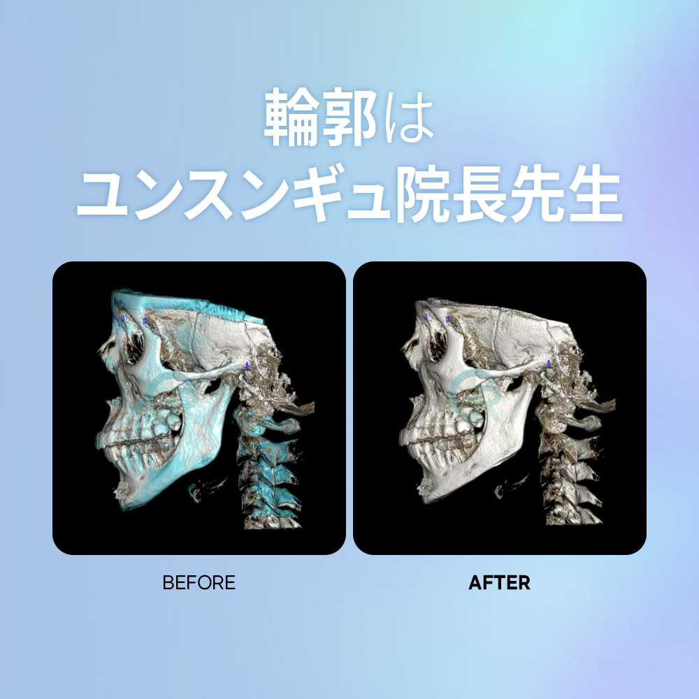 実際の患者様による輪郭整形の体験談。