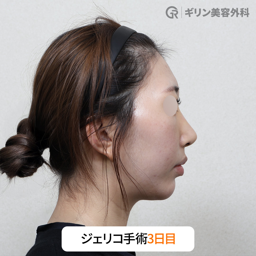 施術から3日後に社会復帰した実際の患者