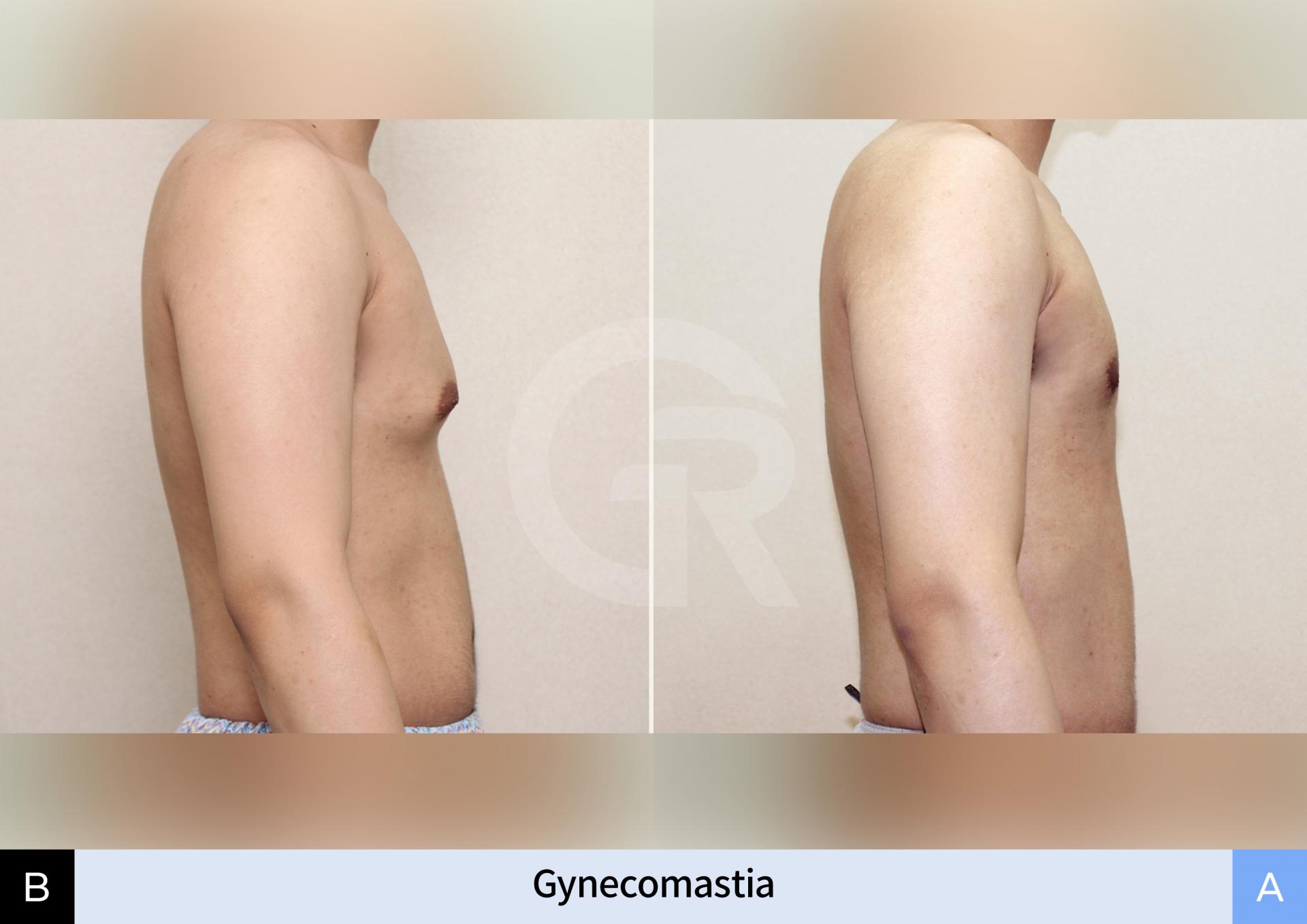 male-chest-liposuction-result.jpg (2).jpg