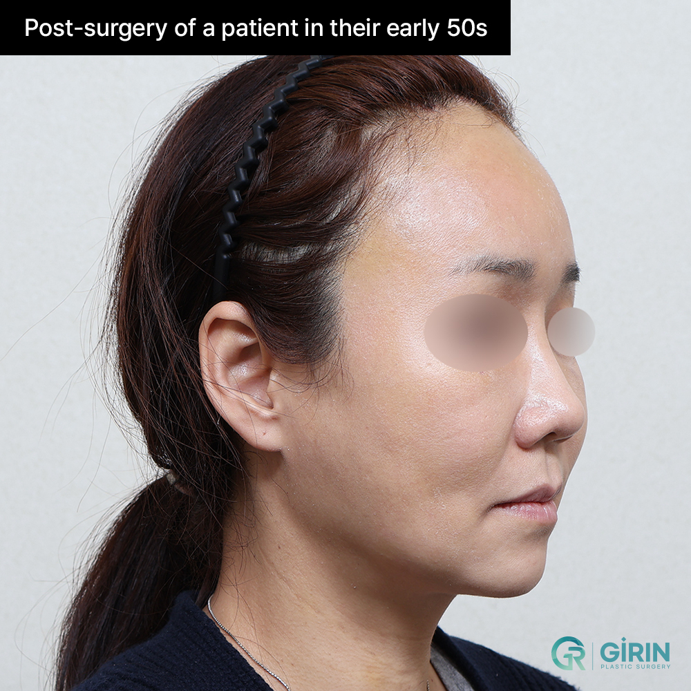 Lower face lifted with minimal incisions and no visible scars