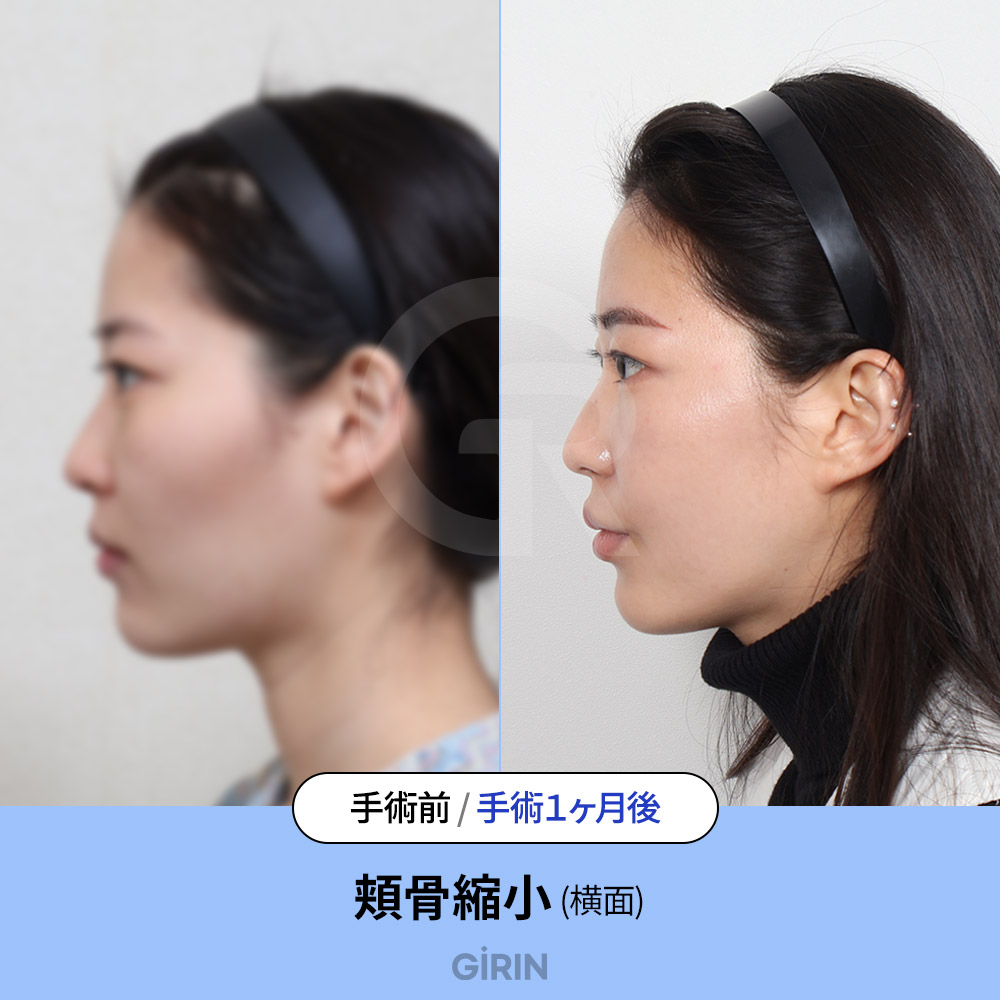 回復は腫れ期→骨癒合→軟部組織の順に進行。