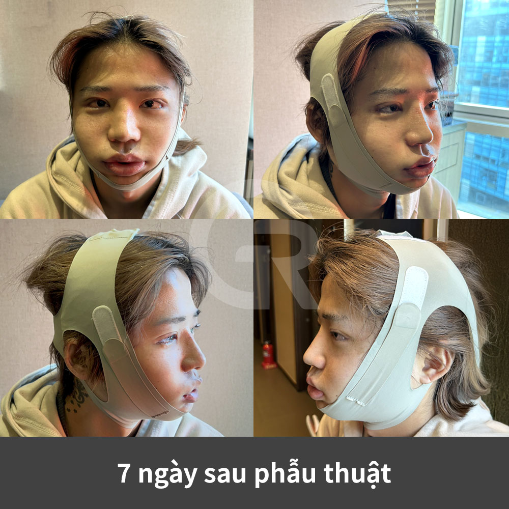 Nâng mũi nam tự nhiên tại Hàn Quốc thường hướng đến đường mũi thẳng hoặc bán thẳng phù hợp với tổng thể cấu trúc khuôn mặt.
