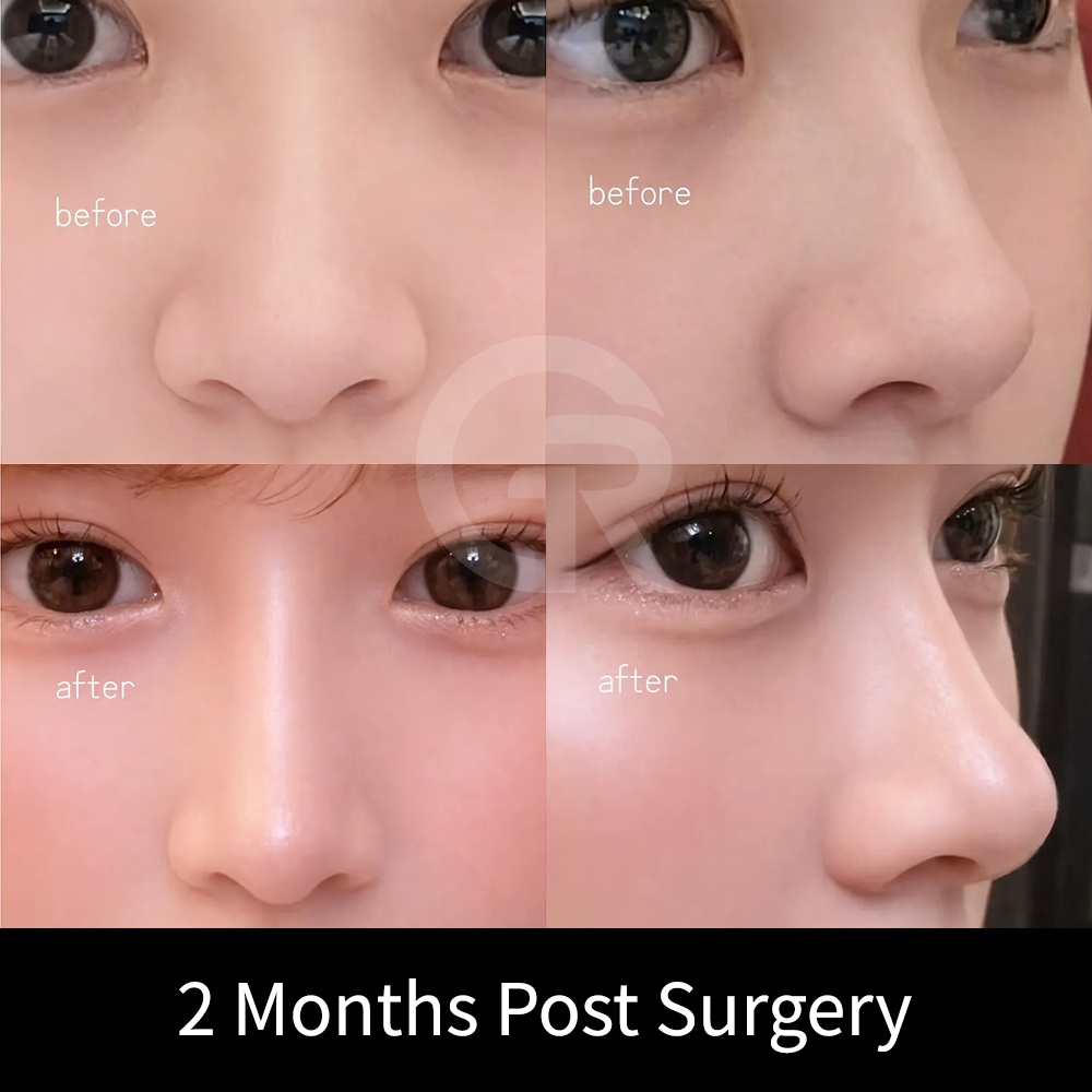A Winter nose style requires detailed balance between the nasal bridge, nasal tip, and frontal view, rather than simply increasing height.