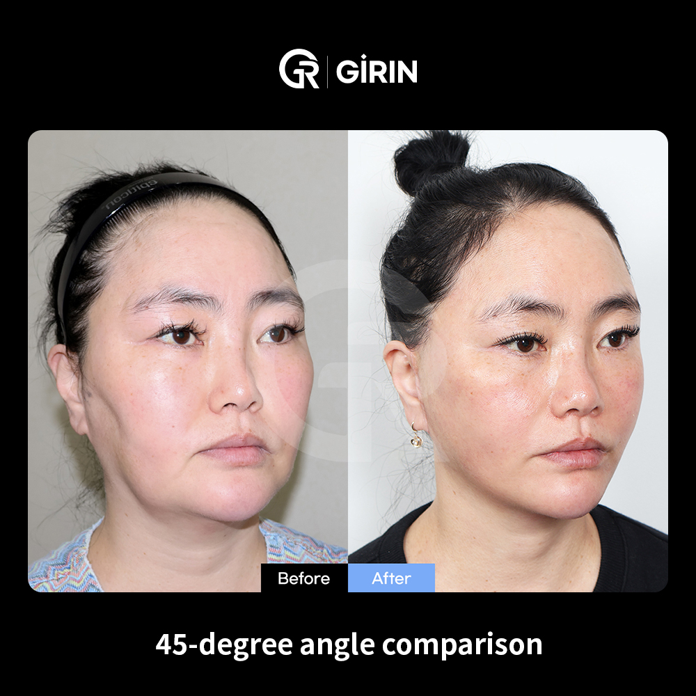 Facelift surgery costs in Korea vary depending on surgical scope and technique