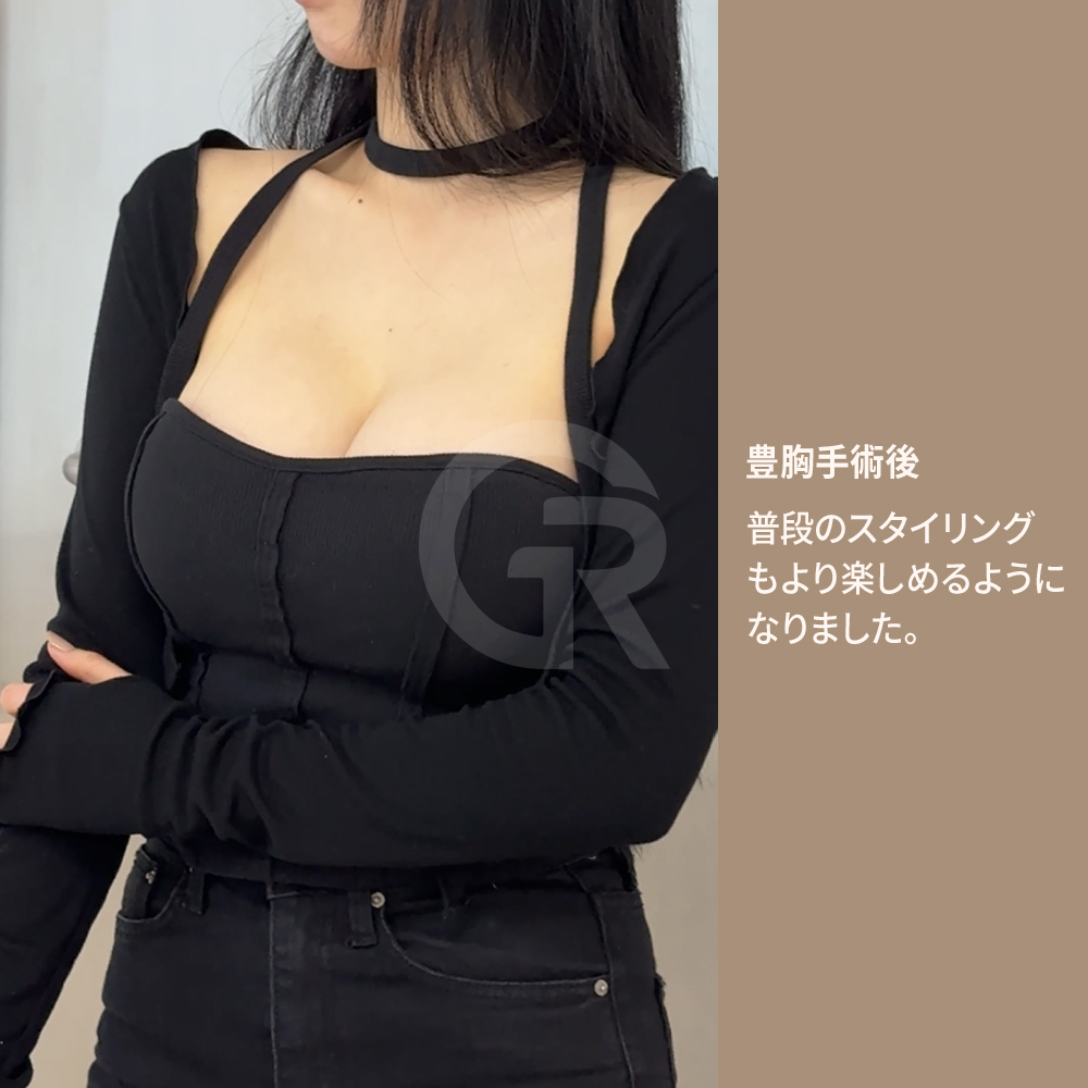 フィットネスやヨガなどを行う女性では、体型バランスを考慮した自然な豊胸デザインが重要になります。