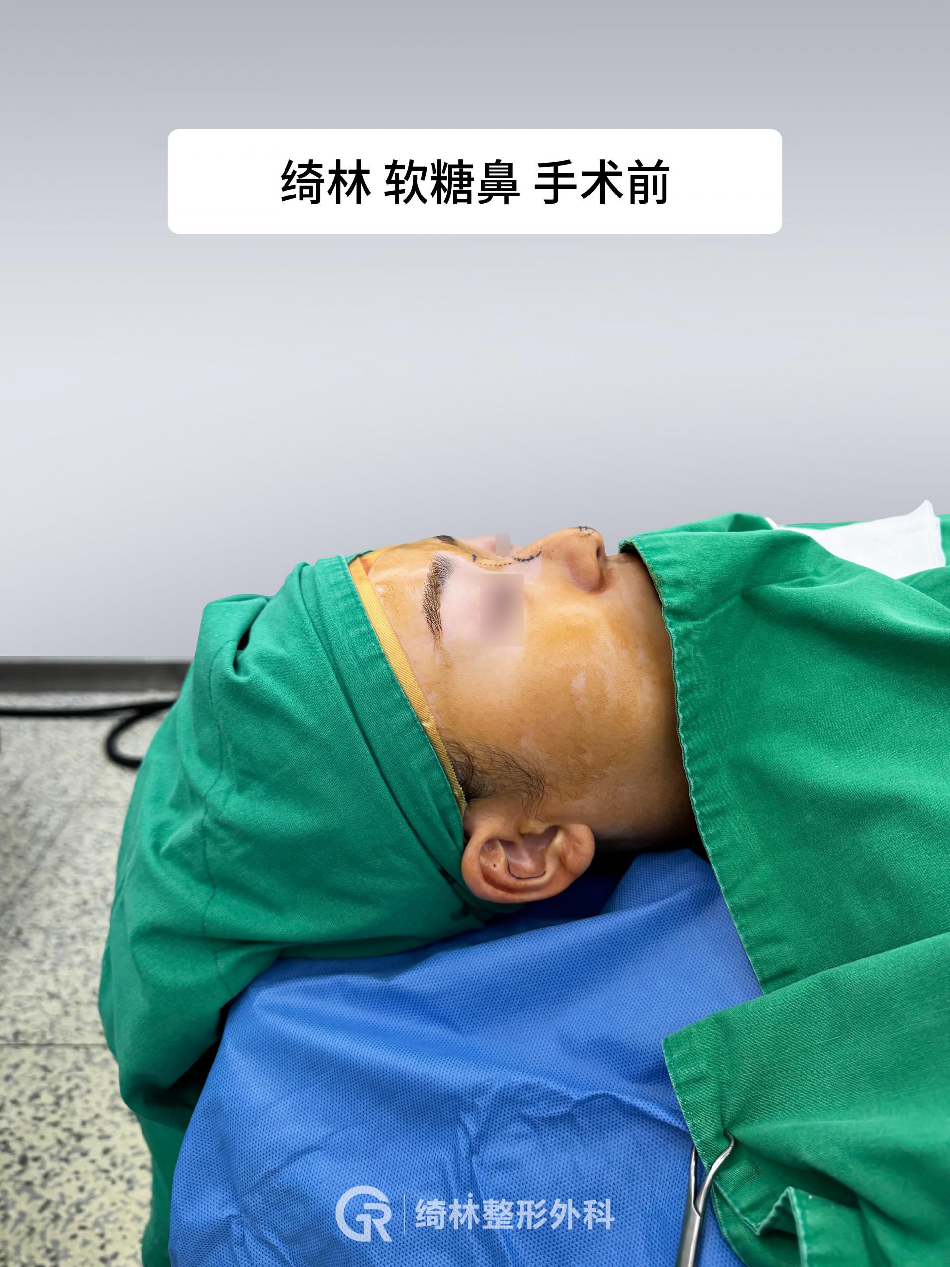 Jellyko无切口隆鼻术操作现场——精密注射，无出血。