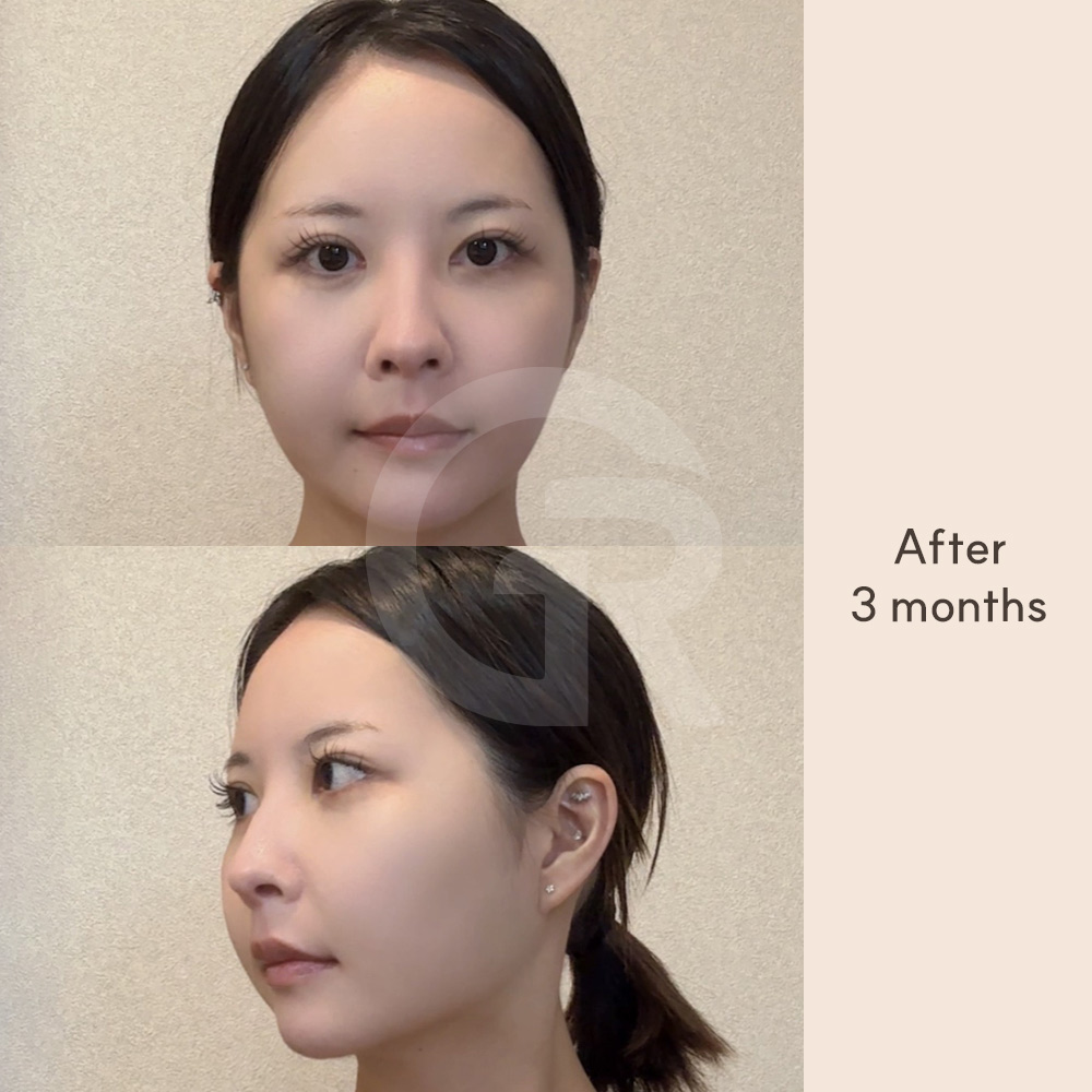 Role of jaw muscles, including the medial pterygoid, in maintaining surgical outcomes and preventing relapse after orthognathic surgery.