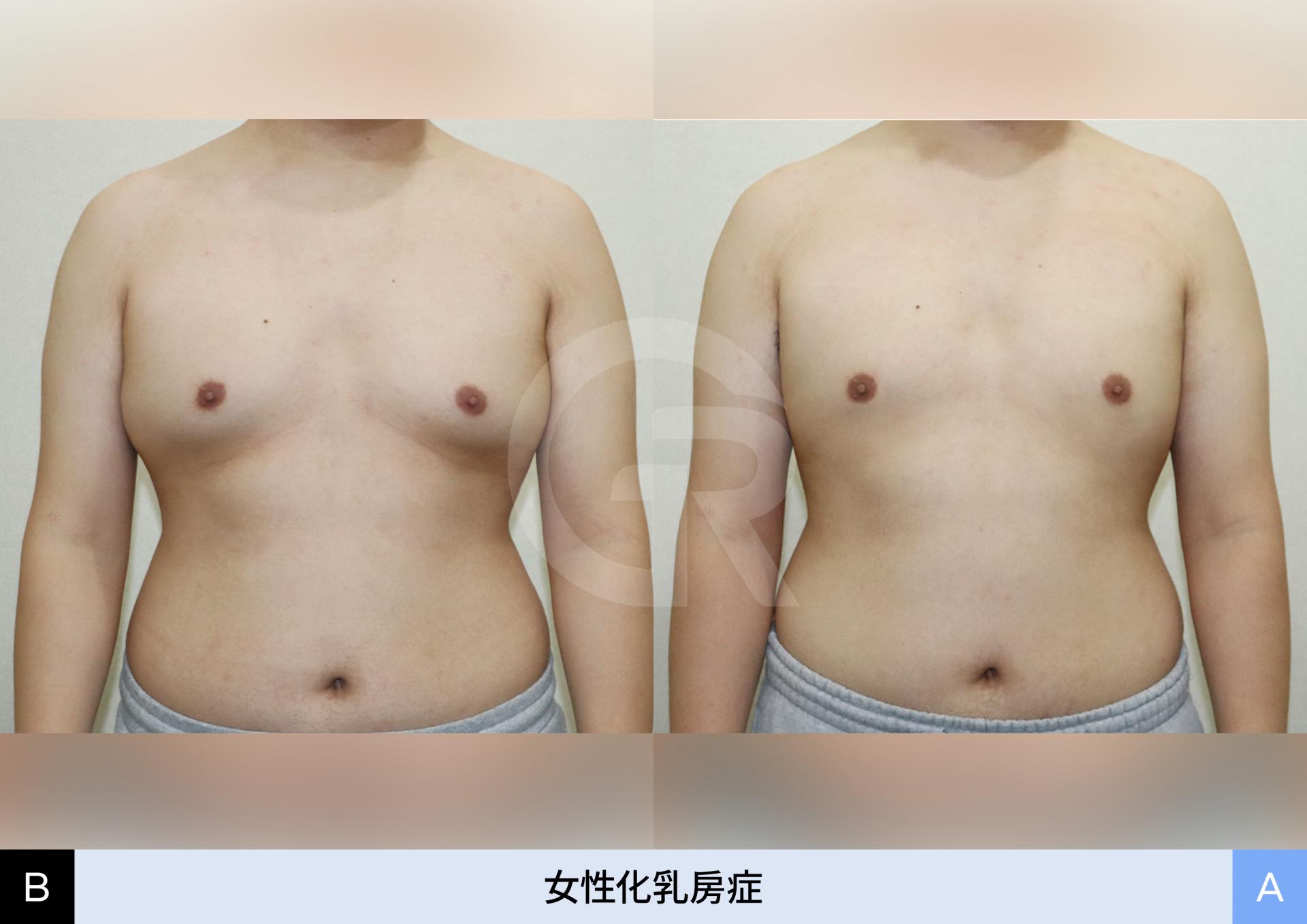 超音波検査で乳腺と脂肪を診断する様子