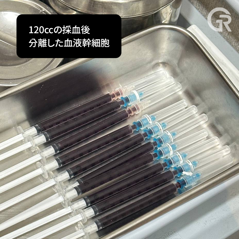 成長因子を用いた頭皮注入治療