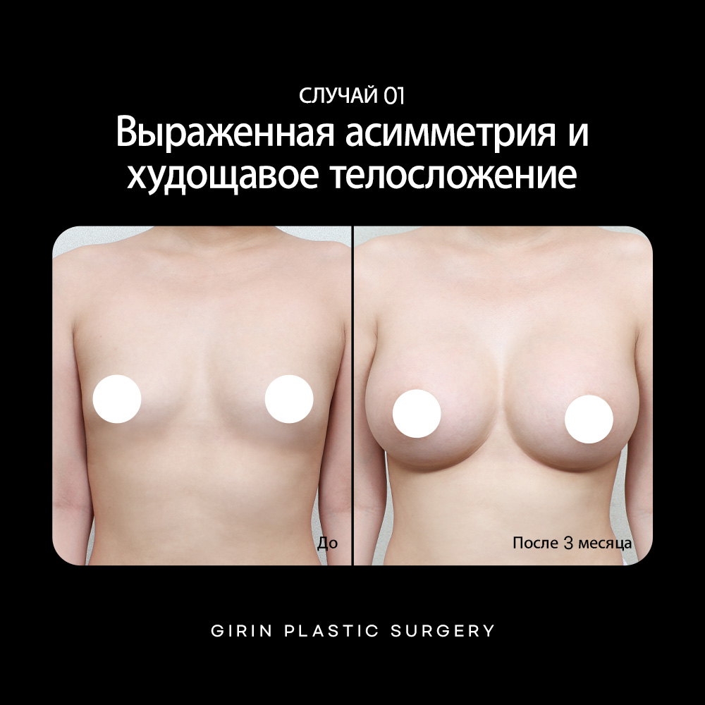 Увеличение груди в Корее по технологии UU-Line – мягкий двойной изгиб