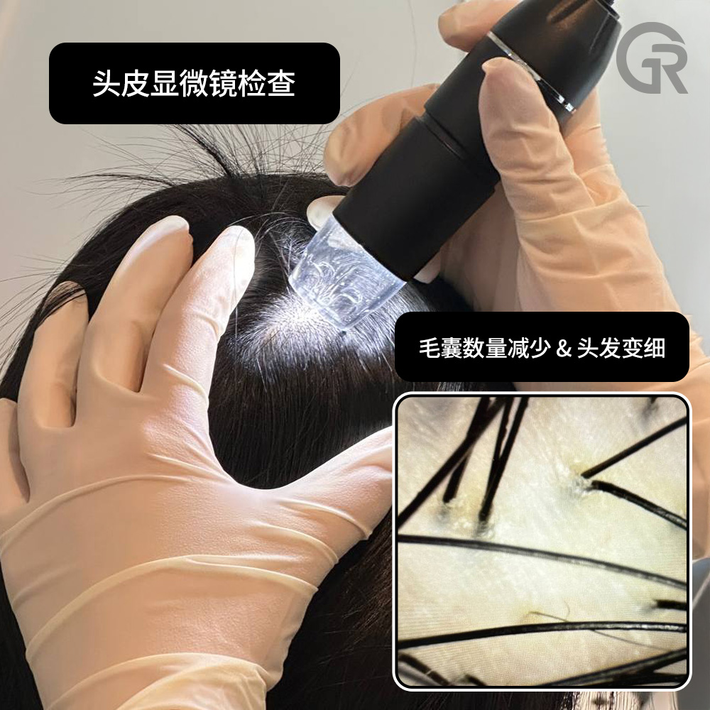 改善头皮环境的干细胞治疗