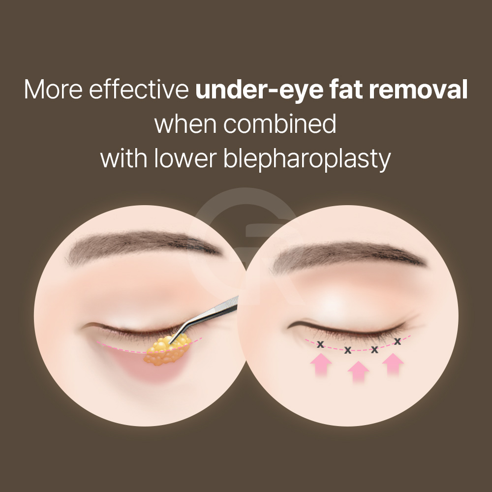Lifting your brows manually can help identify whether eyebrow descent is the main cause.