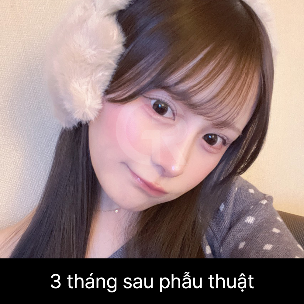 Khi sống mũi bị lệch, việc nâng quá cao có thể khiến bất đối xứng trông rõ hơn.