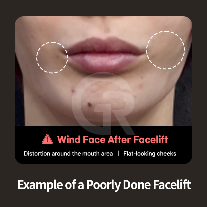 Subperiosteal dissection allows access to deeper retaining ligaments involved in midface aging.