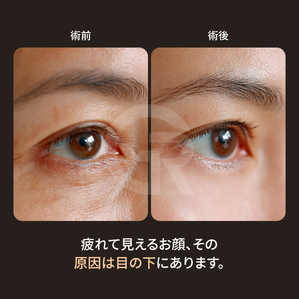 目の下の老化は単なる疲れではなく、構造的な変化によって生じます。