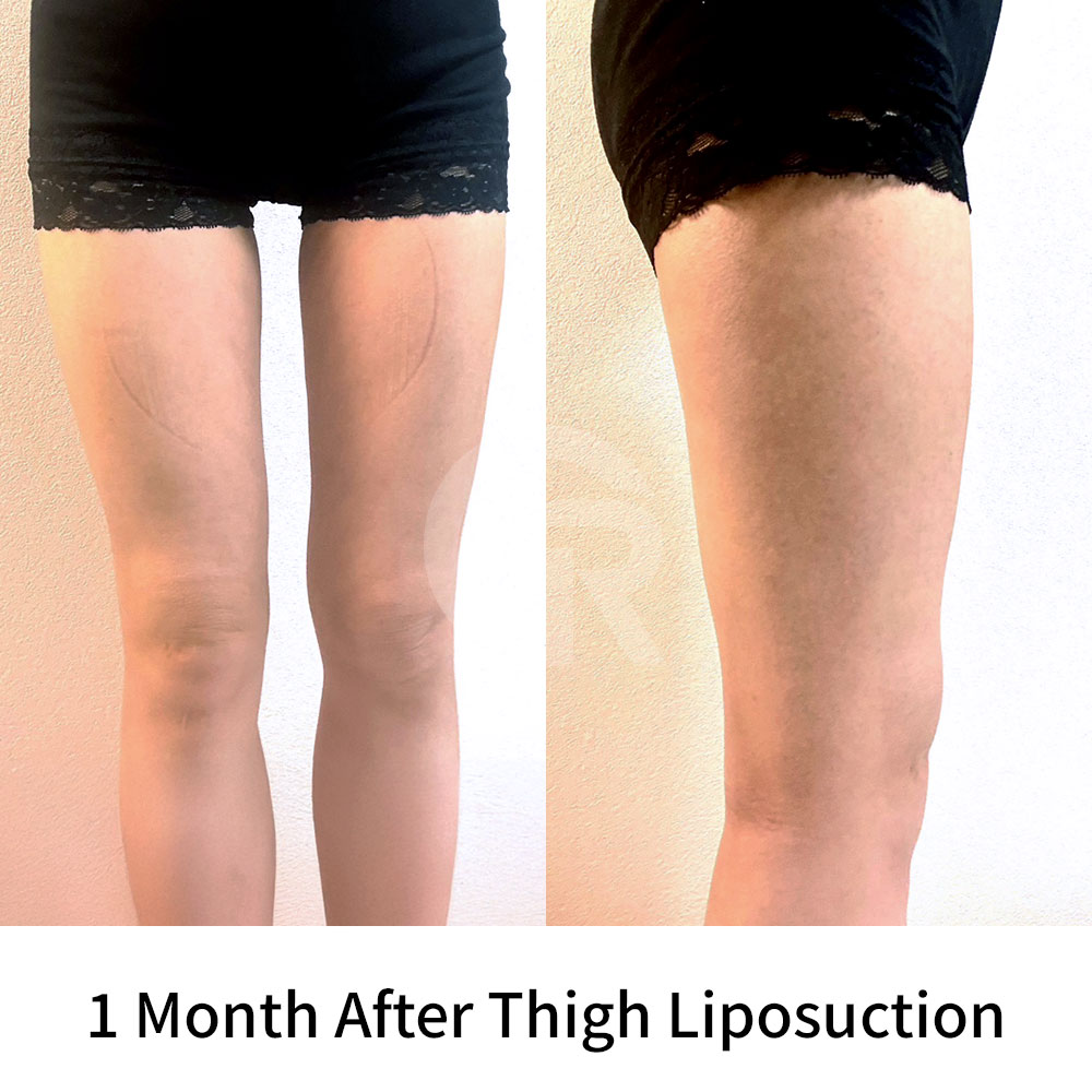 A thigh gap should not be the only goal of surgery; natural balance matters more.