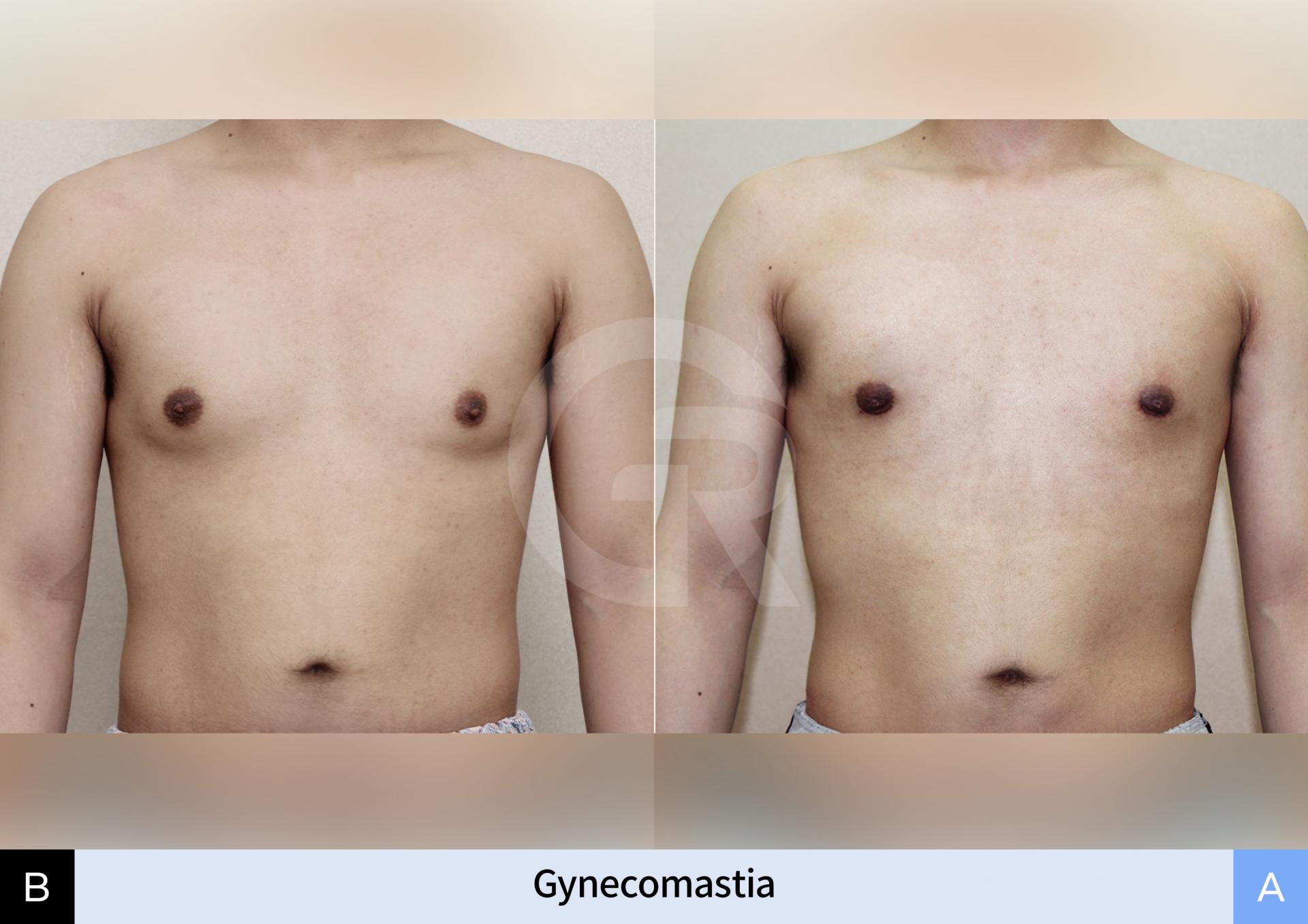 male-chest-liposuction-result.jpg.jpg