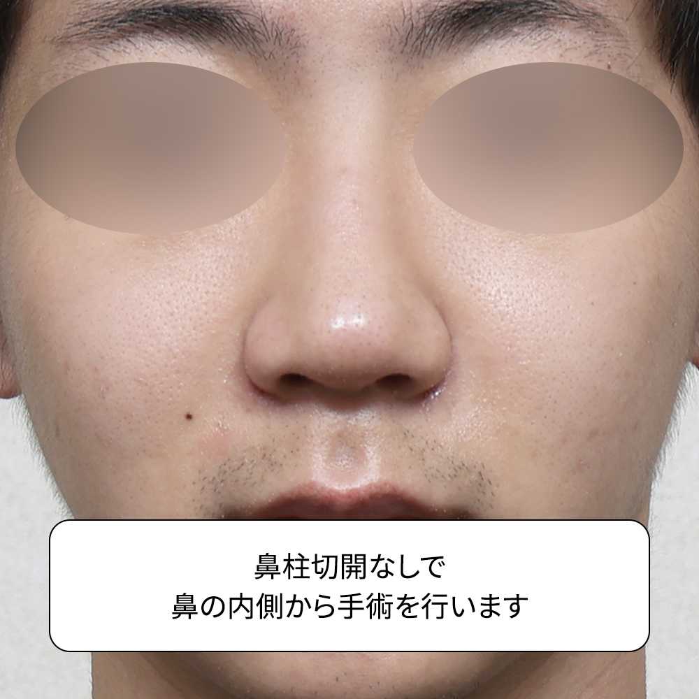 男性のハンプノーズを改善する韓国の無プロテーゼ鼻整形 Jellyko。