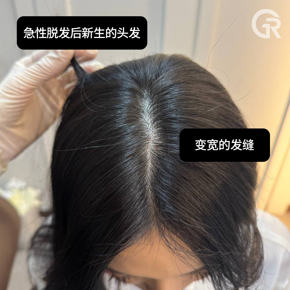 头皮显微镜下的精准诊断