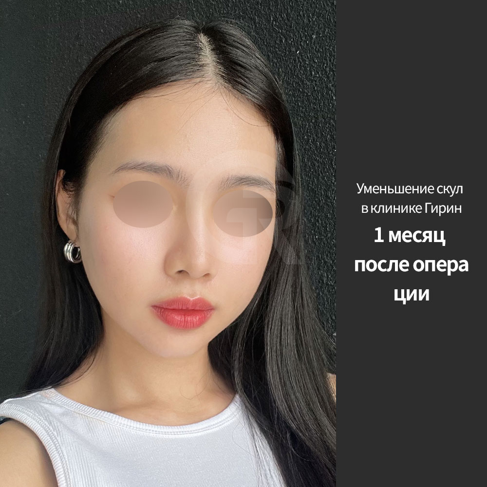 После уменьшения скул лицо выглядит мягче, а глаза, нос и губы становятся визуально более выразительными.