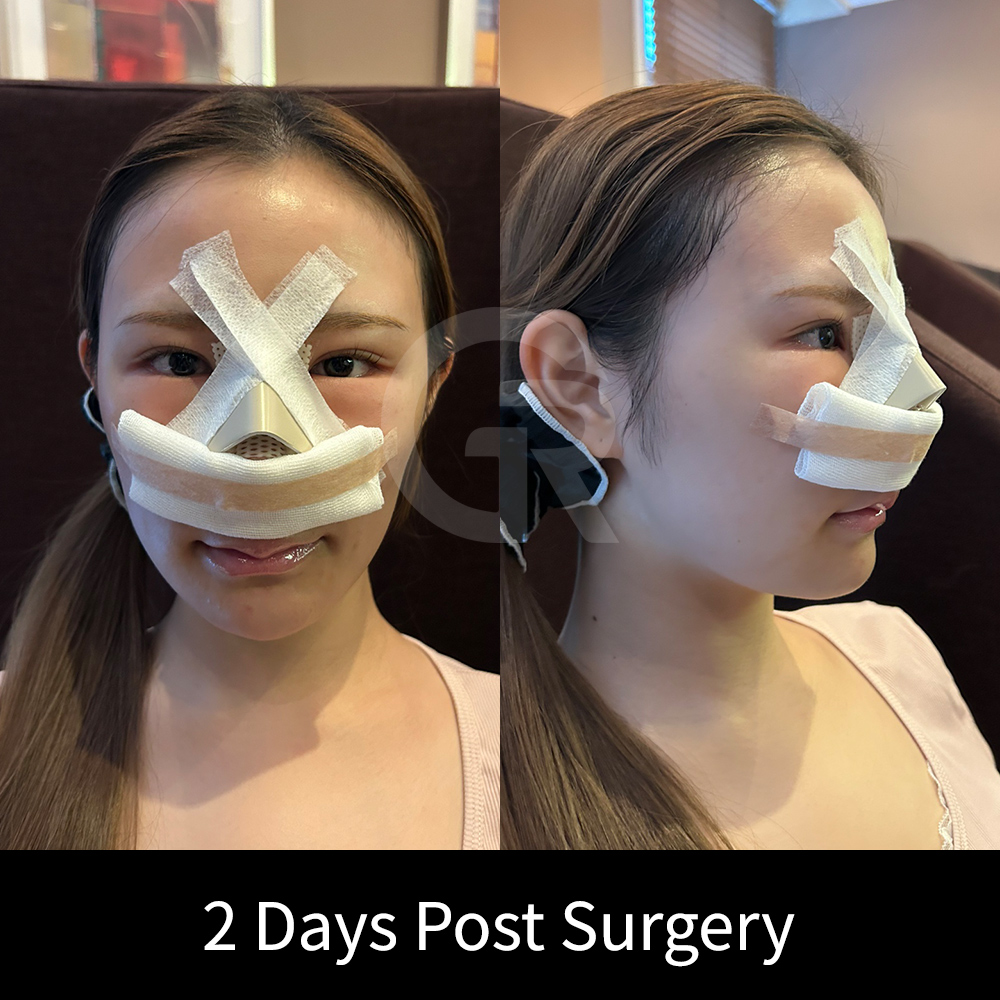 Girin Plastic Surgery in Korea plans rhinoplasty designs based on each patient’s original nasal structure and facial proportions.