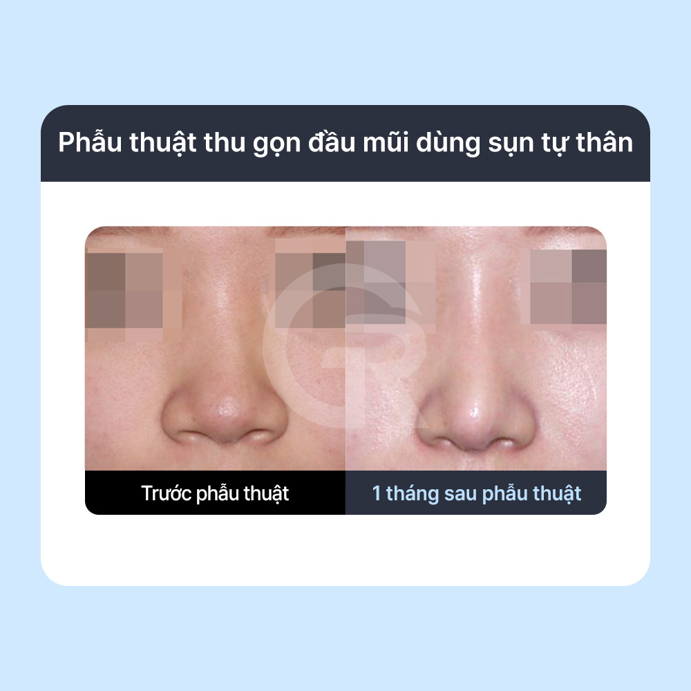 Sụn sườn tự thân có thể hỗ trợ tốt trong các trường hợp tái phẫu thuật hoặc cần tái tạo cấu trúc mũi.