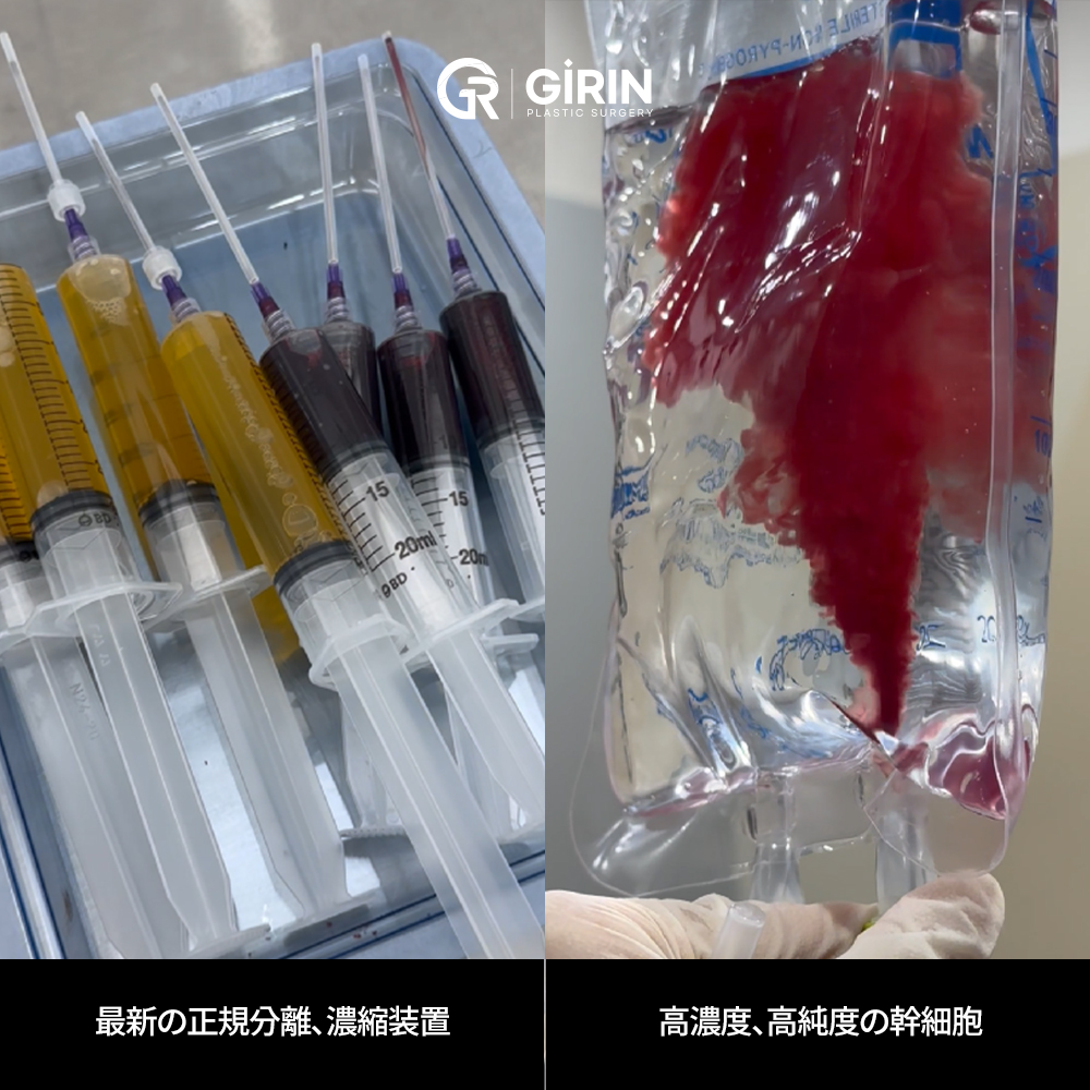 PRPと幹細胞注射の違いを正しく理解