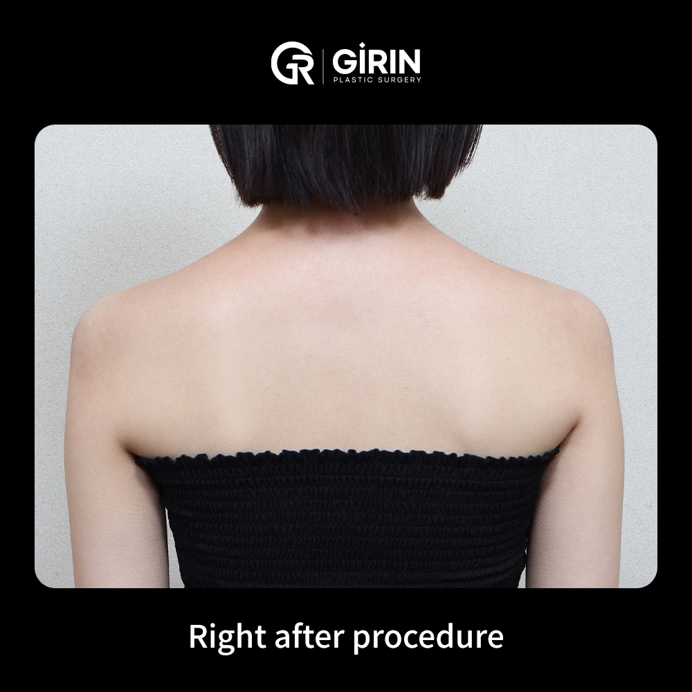 Trusted shoulder filler clinic in Gangnam for natural and symmetrical results