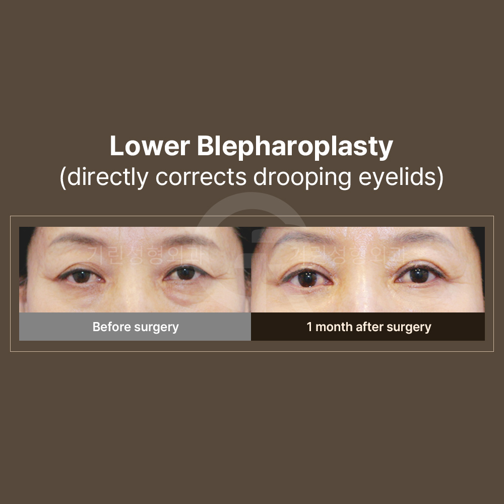 Forehead lift not only improves eye opening but also reduces forehead wrinkles.