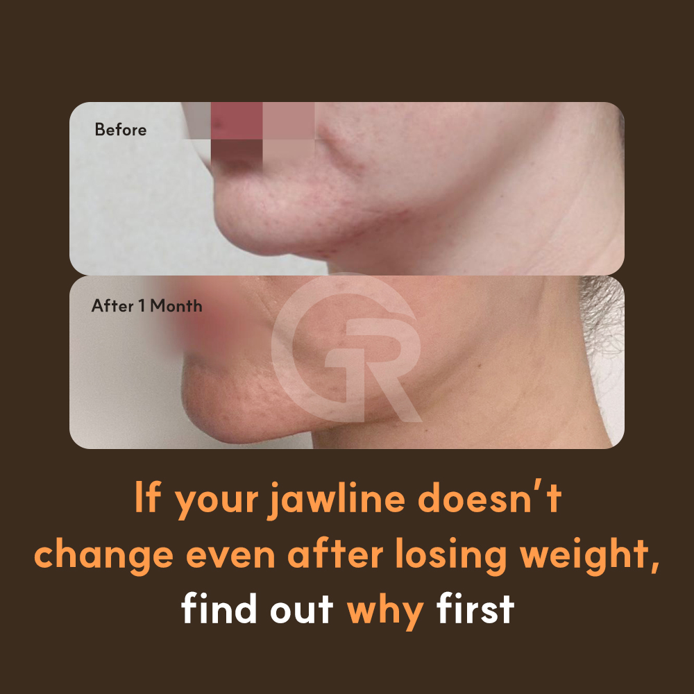 If the area under the chin looks heavy from the side, it is important to check whether the boundary between the chin and neck has become blurred.
